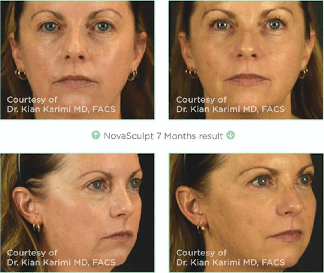 Chicago, IL NovaThreads Procedure Dr. Yates Lifestyle Med