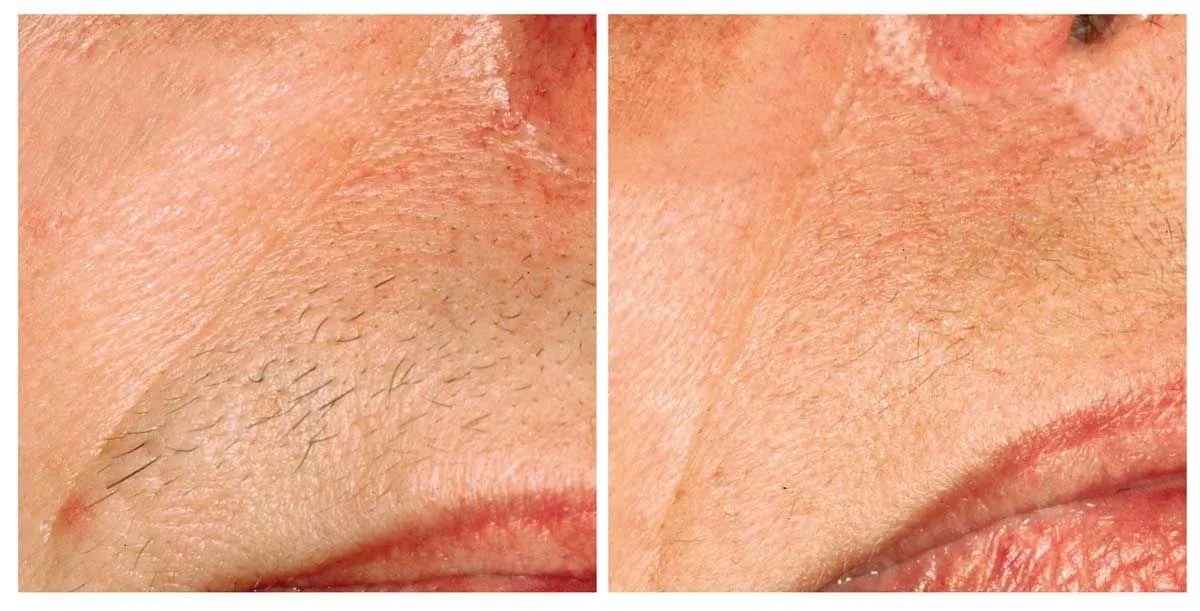 Laser Resurfacing Treatment in Burlington Modern You Medical Aesthetics