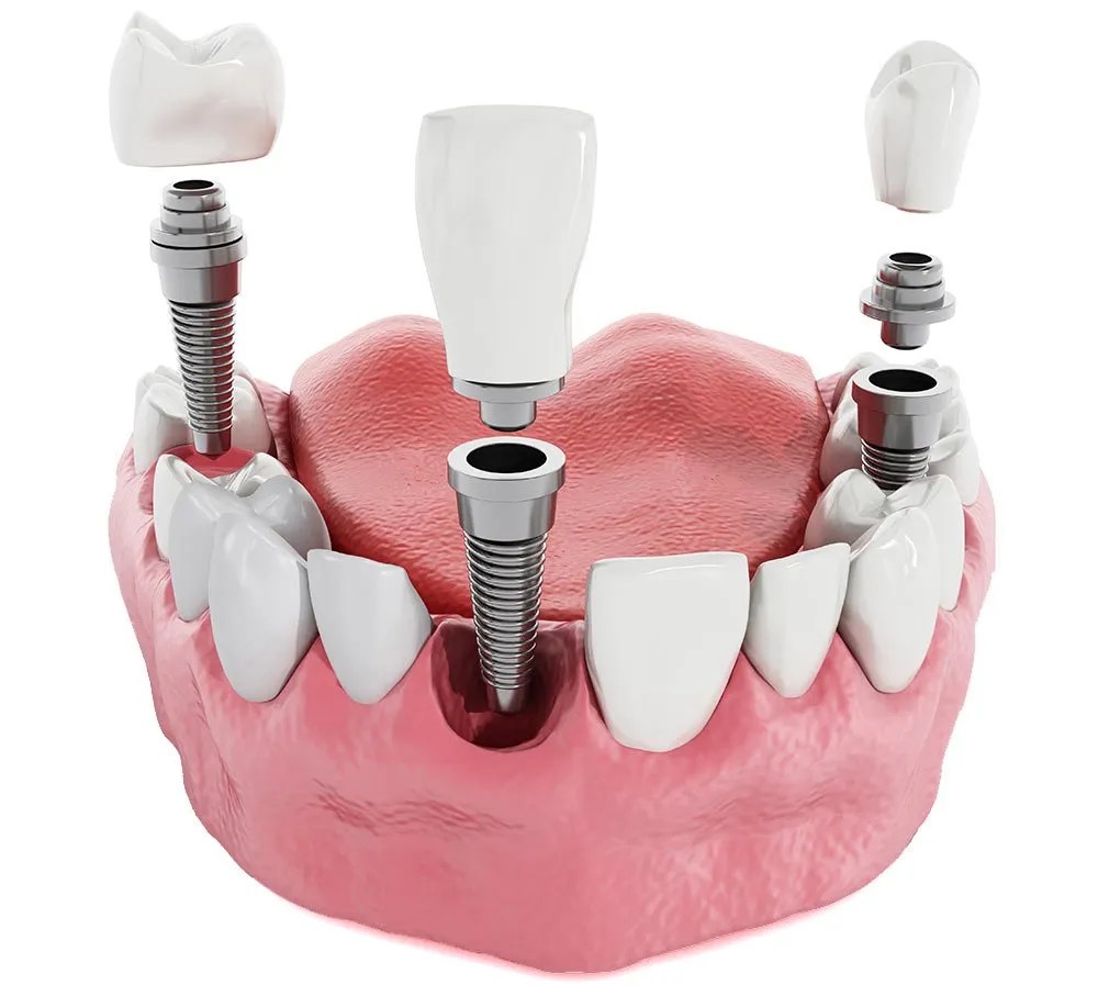 Dental Implants Manteca Crowns Veneers Valley Oak