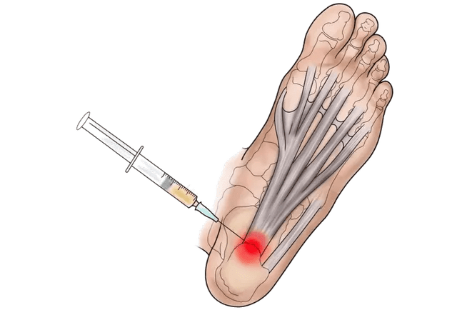 Details 120+ steroid shot for heel pain best jtcvietnam.edu.vn