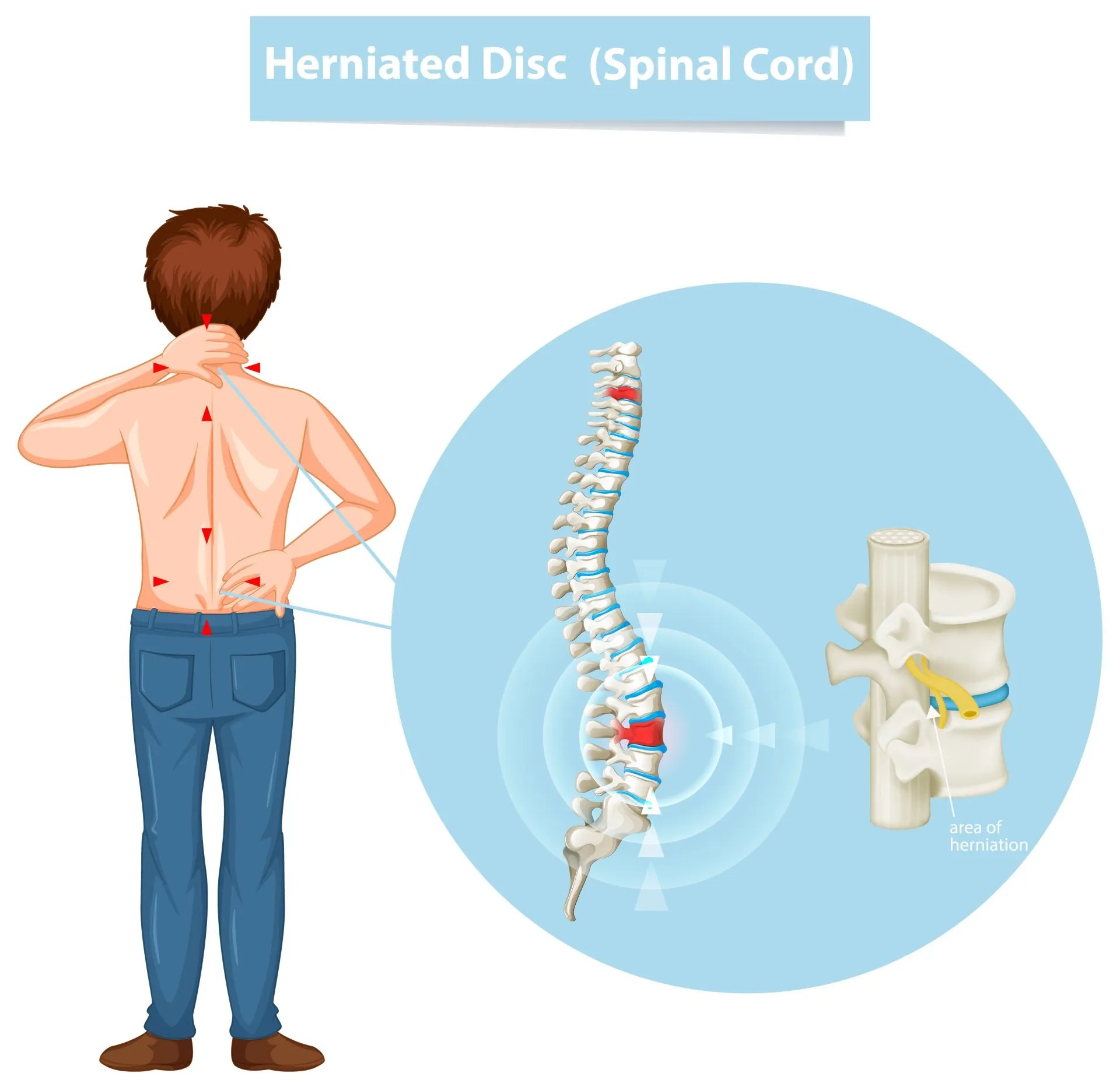 Slipped Disk? The Importance of MRI to detect a Herniated Disc
