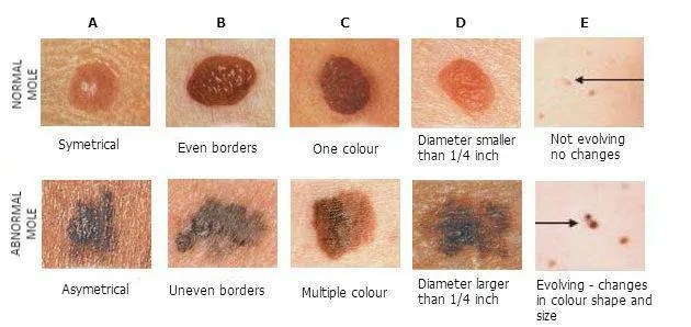 Abcdef's Of Changing Moles & Melanoma