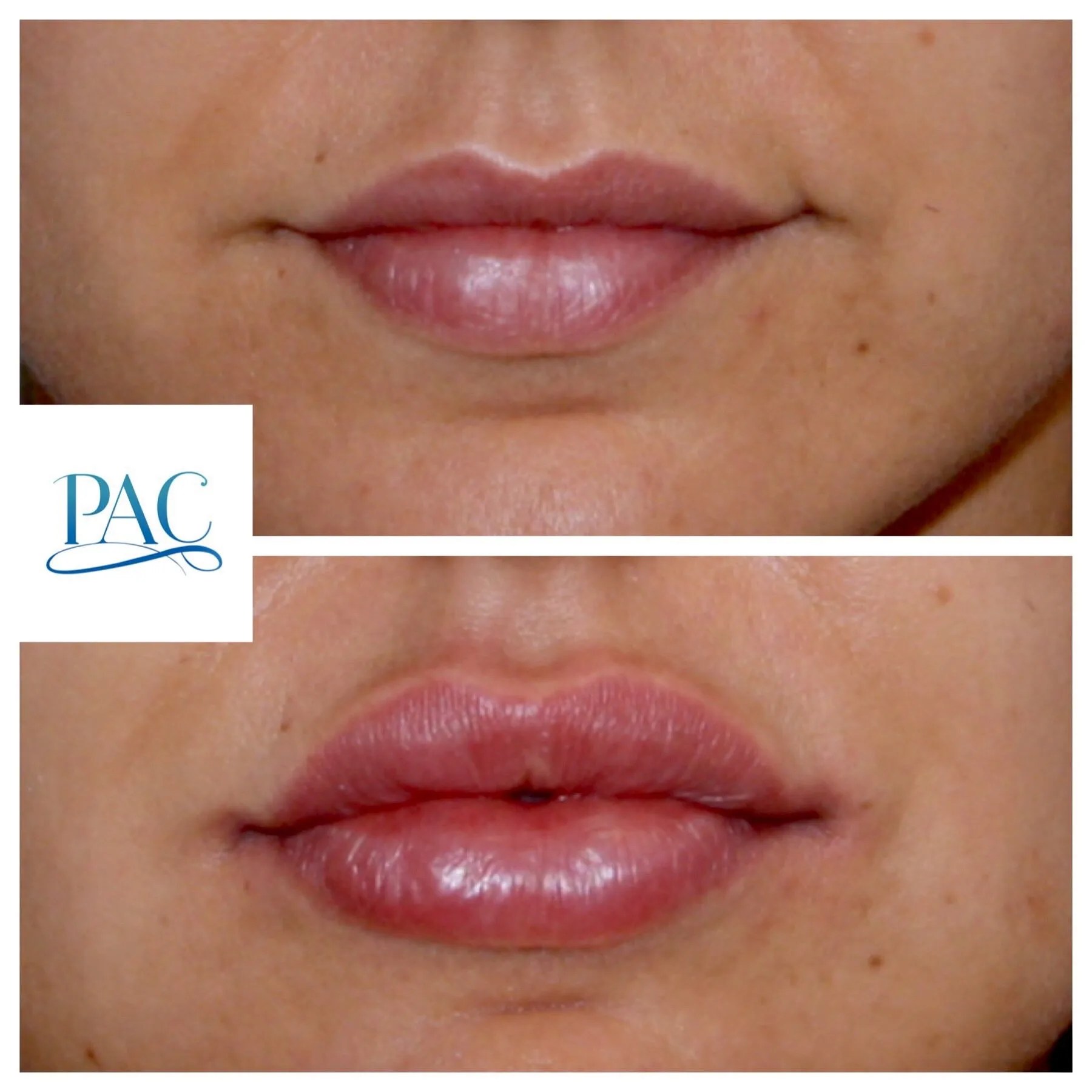Dermal Fillers Boca Raton Full Face Lips Prestige Aesthetics