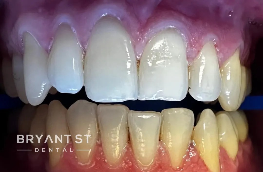 Best Dentist in Palo Alto Dentistry Bryant St Dental