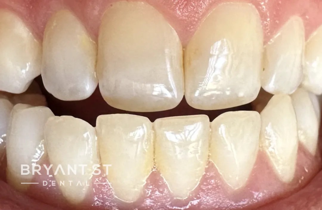 Best Dentist in Palo Alto Dentistry Bryant St Dental