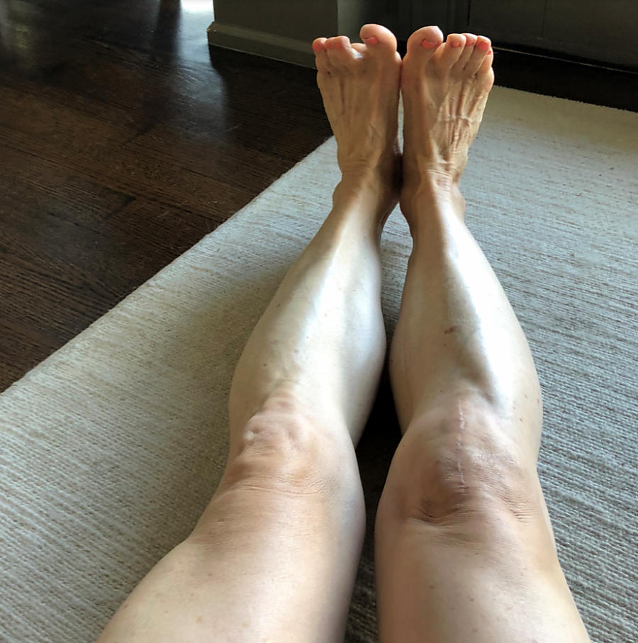 Returning To Yoga After A Total Knee Replacement LISA BARDARSON