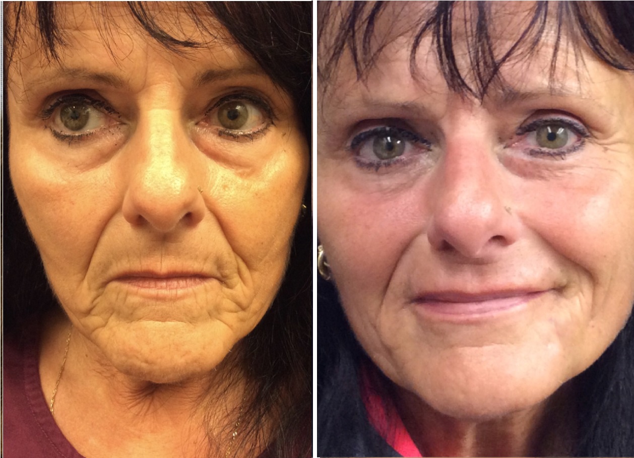 Lisa Bunin MD Liquid Face Lift Before & After Photos Lisa Bunin MD