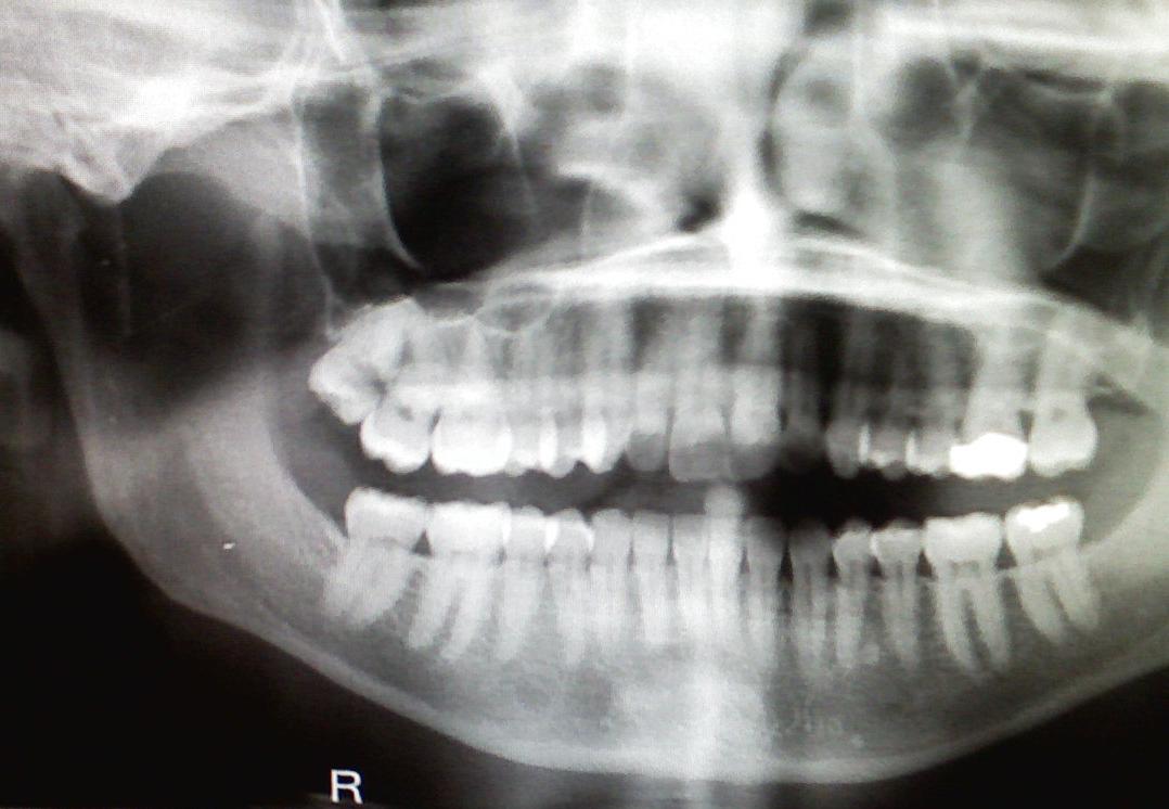Wisdom Tooth Removal Tips Photos