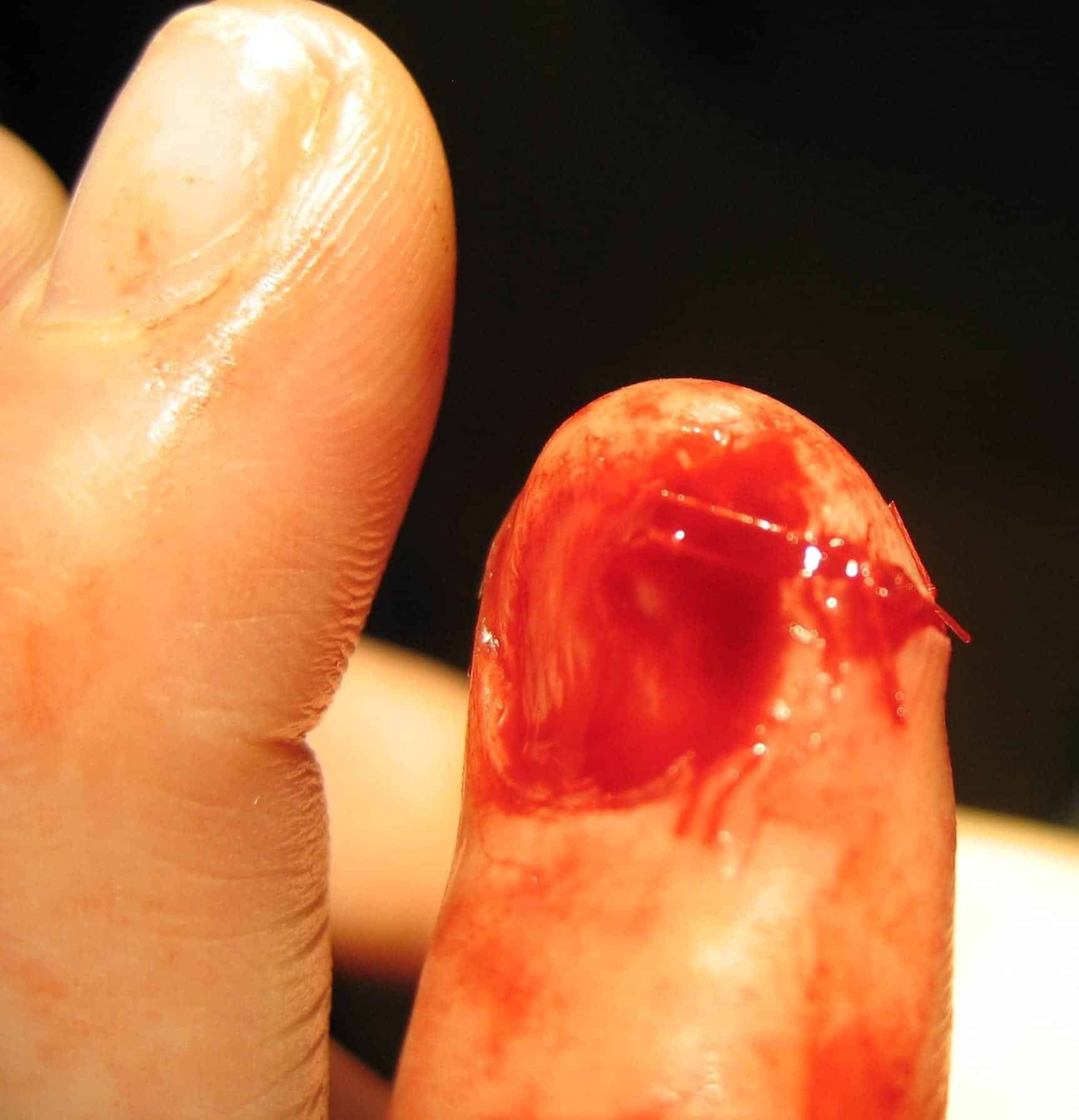 Fingertip Injury • LITFL • Bamboozler