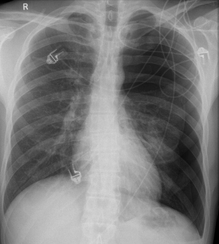 CXR Case 101 • LITFL • Chest Xray SelfAssessment Quiz