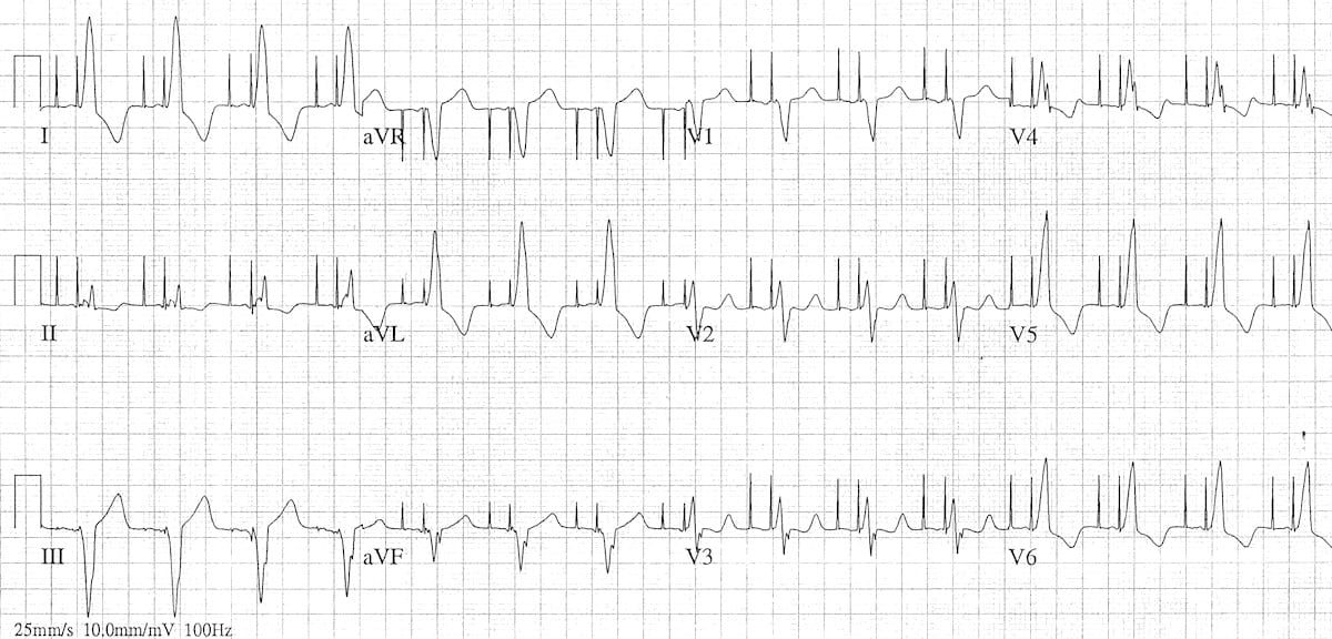 Pacemaker Rhythms Normal Patterns • LITFL • ECG Library Diagnosis