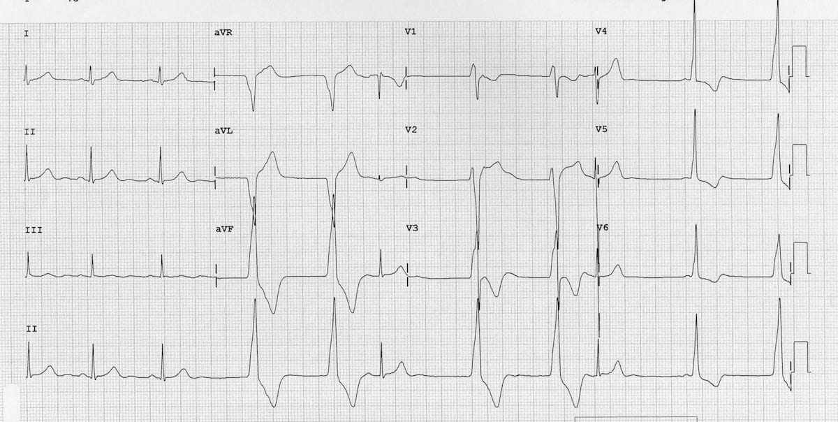 Accelerated Idioventricular Rhythm (AIVR) • LITFL • ECG
