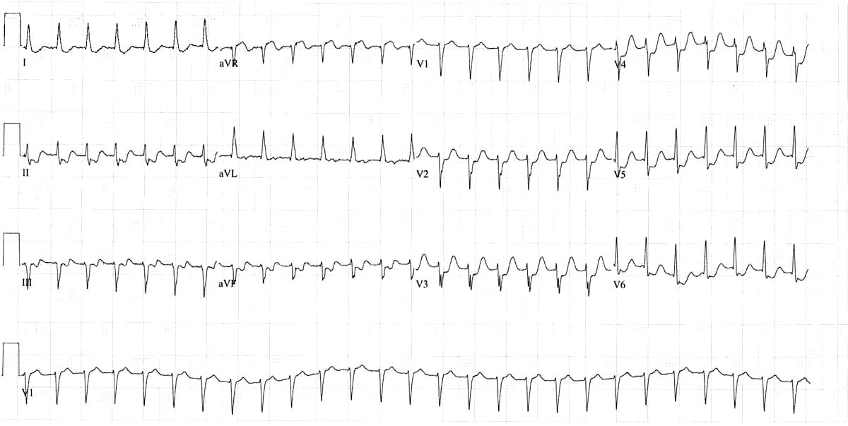 LMCA occlusion ST Elevation in aVR • LITFL • ECG Library Diagnosis