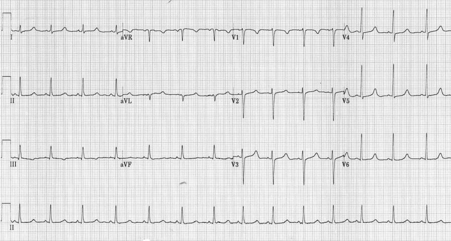 Hypocalcaemia ECG changes • LITFL • ECG Library