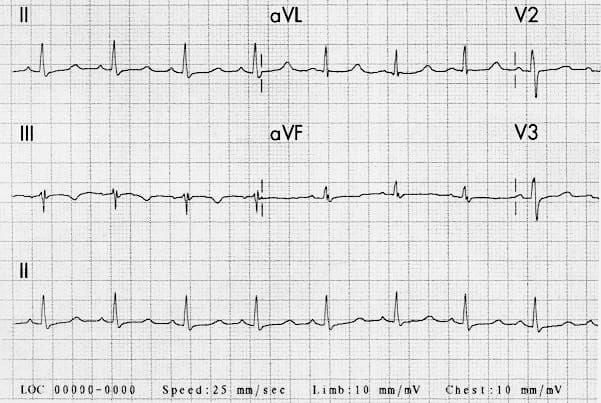 Hypocalcaemia ECG changes • LITFL • ECG Library