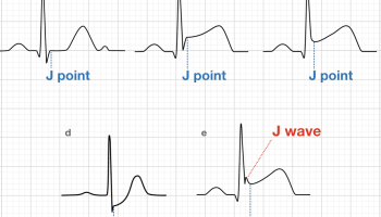 J Point Ecg Interval Litfl Ecg Library Basics