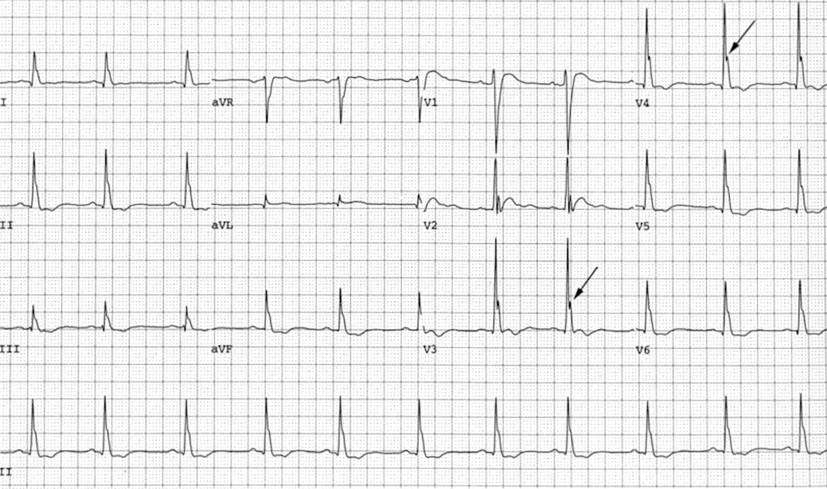 Hypocalcemia Ecg Changes
