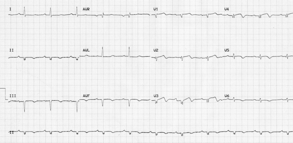 Low QRS Voltage • LITFL • ECG Library Diagnosis