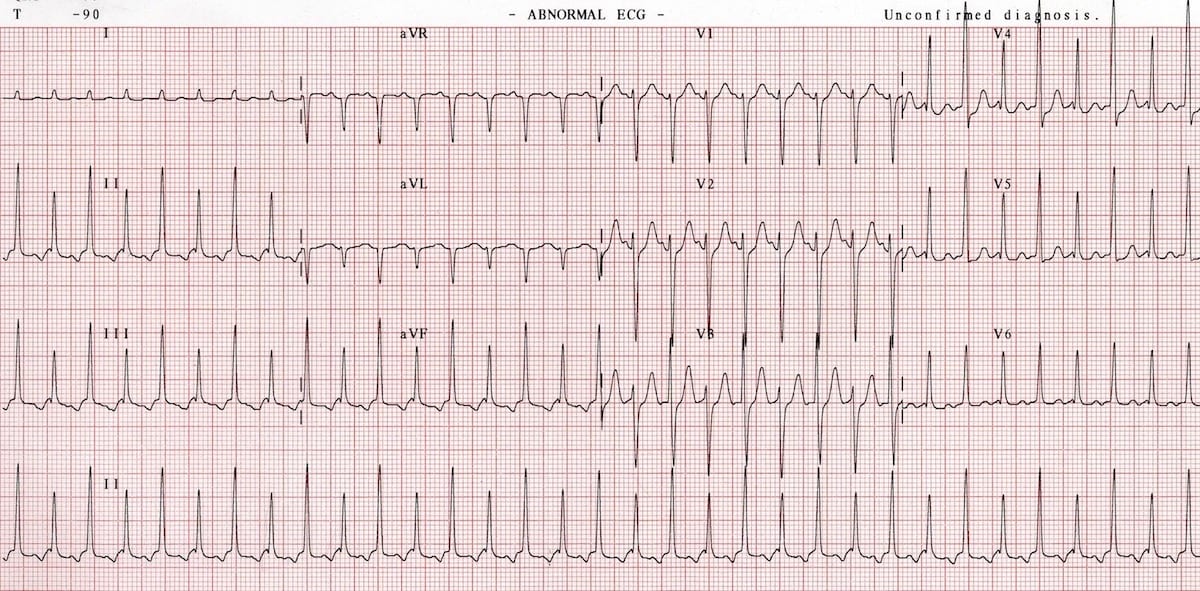 Supraventricular Tachycardia Svt • Litfl • Ecg Library Diagnosis