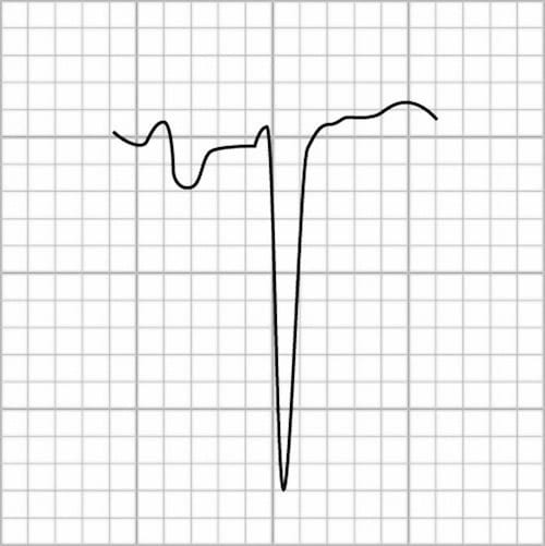 Junctional Rhythm Inverted P Wave