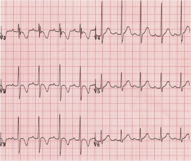 R wave • LITFL • ECG Library Basics