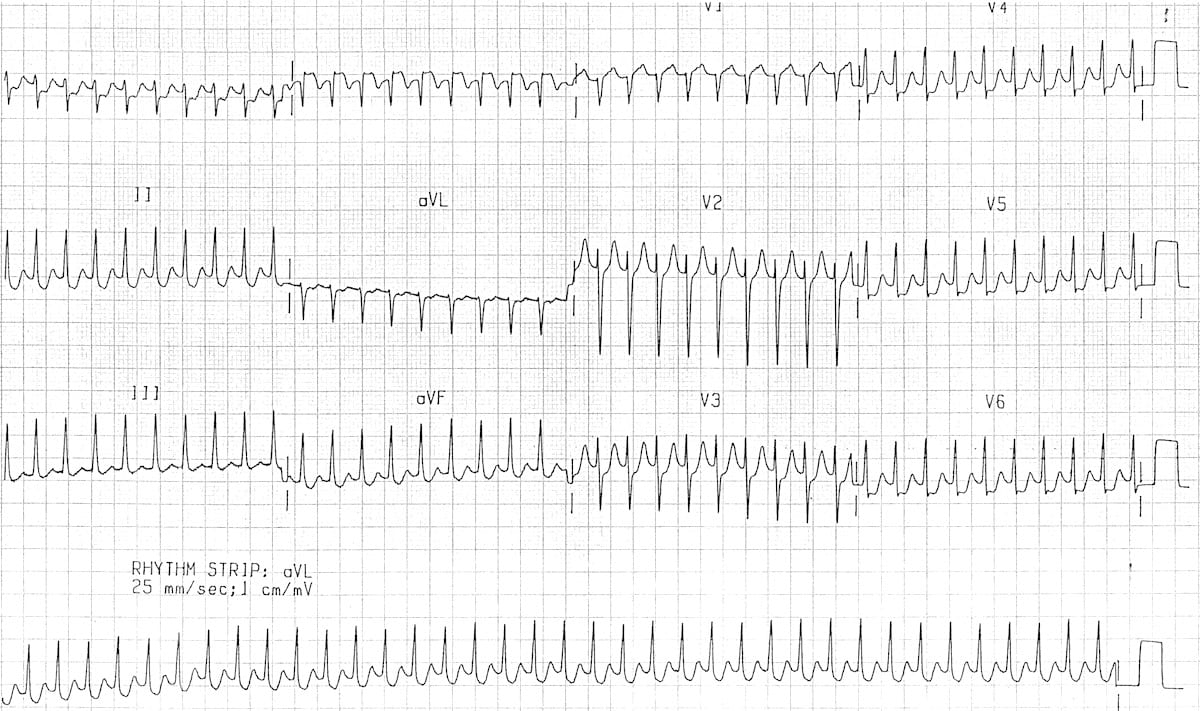 Preexcitation syndromes • LITFL • ECG Library Diagnosis