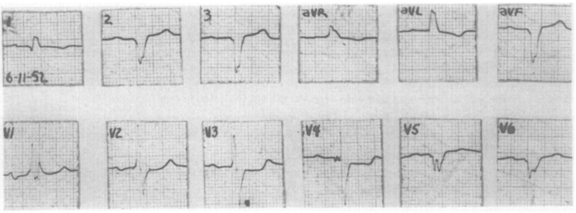 LenègreLev disease • LITFL • Medical Eponym Library