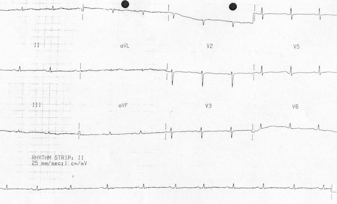 ECG Case 063 • LITFL • ECG Top 100 SelfAssessment Quiz