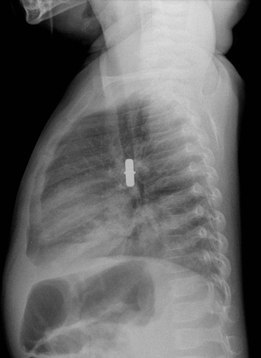 Inhalational Emergency • LITFL • Clinical Cases Paediatric