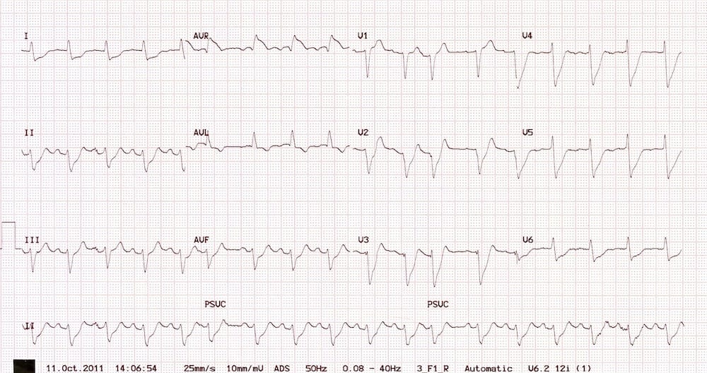 Shock, syncope and severe chest pain • LITFL • ECG Exigency