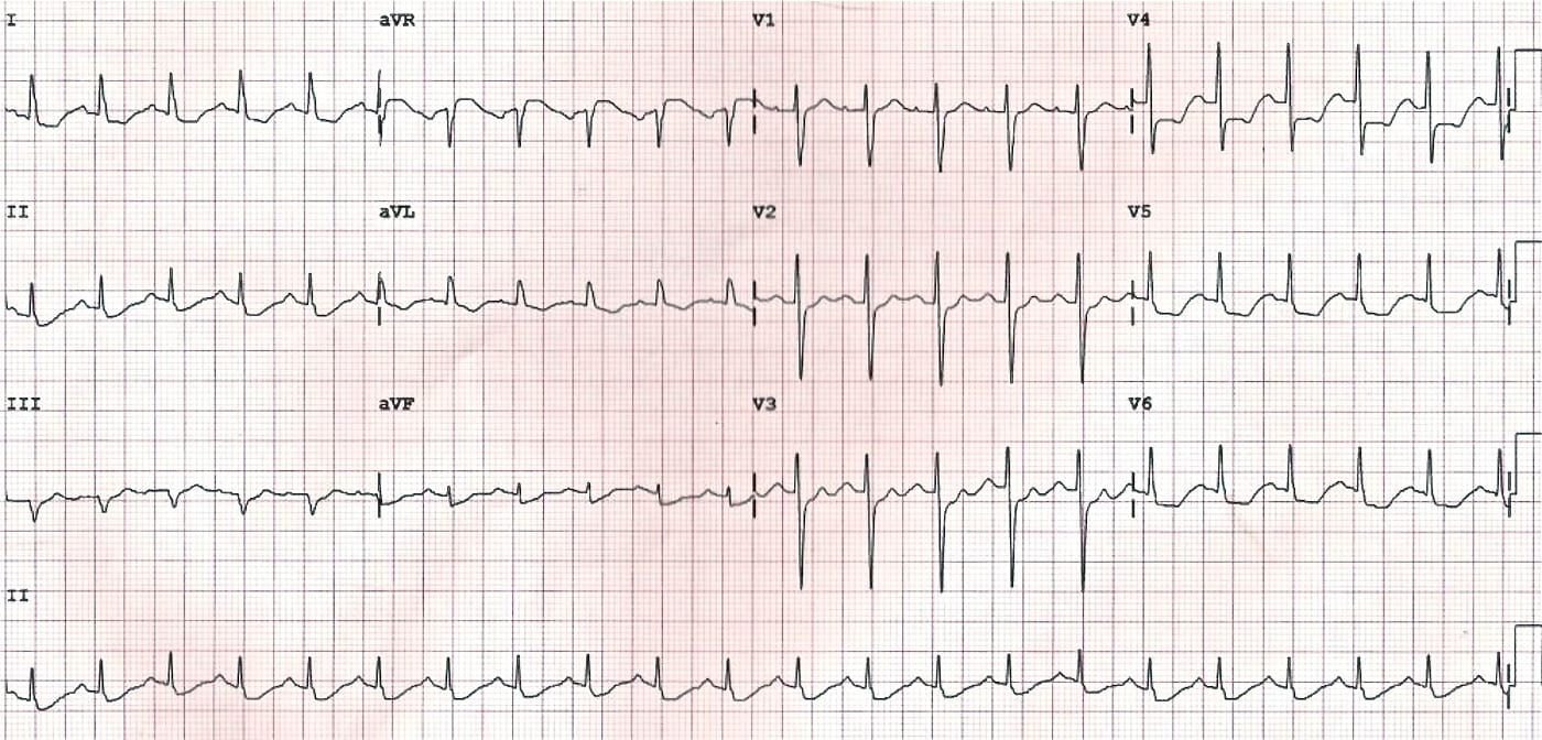 Shock, syncope and severe chest pain • LITFL • ECG Exigency