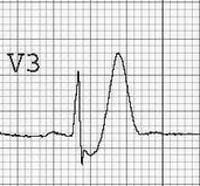 Dewinter Ecg . De Winter T Wave • LITFL • ECG Library Diagnosis