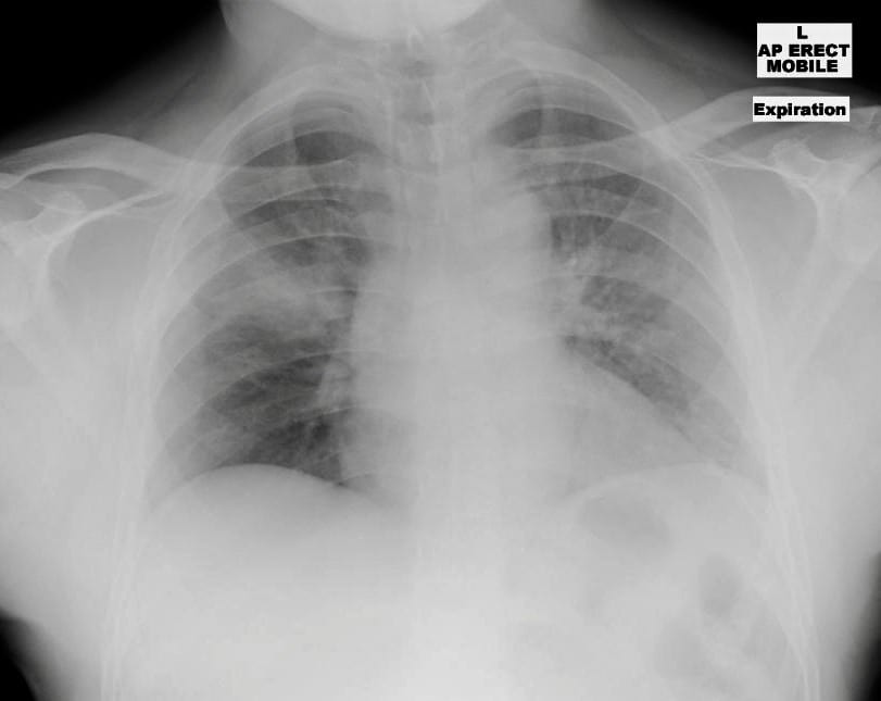 Little Wound, Long Knife • LITFL • Trauma Tribulation