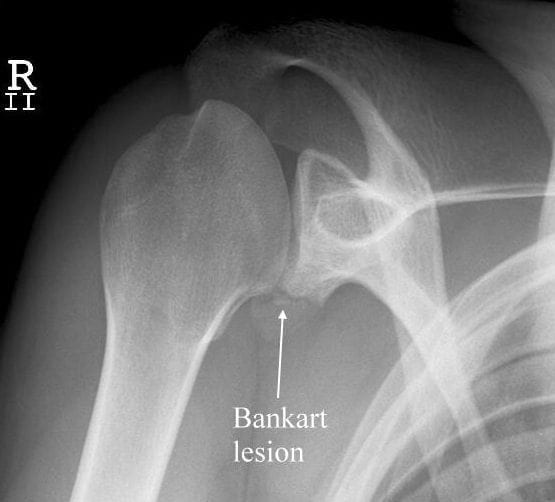 Bankart Lesion • LITFL • Medical Eponym Library