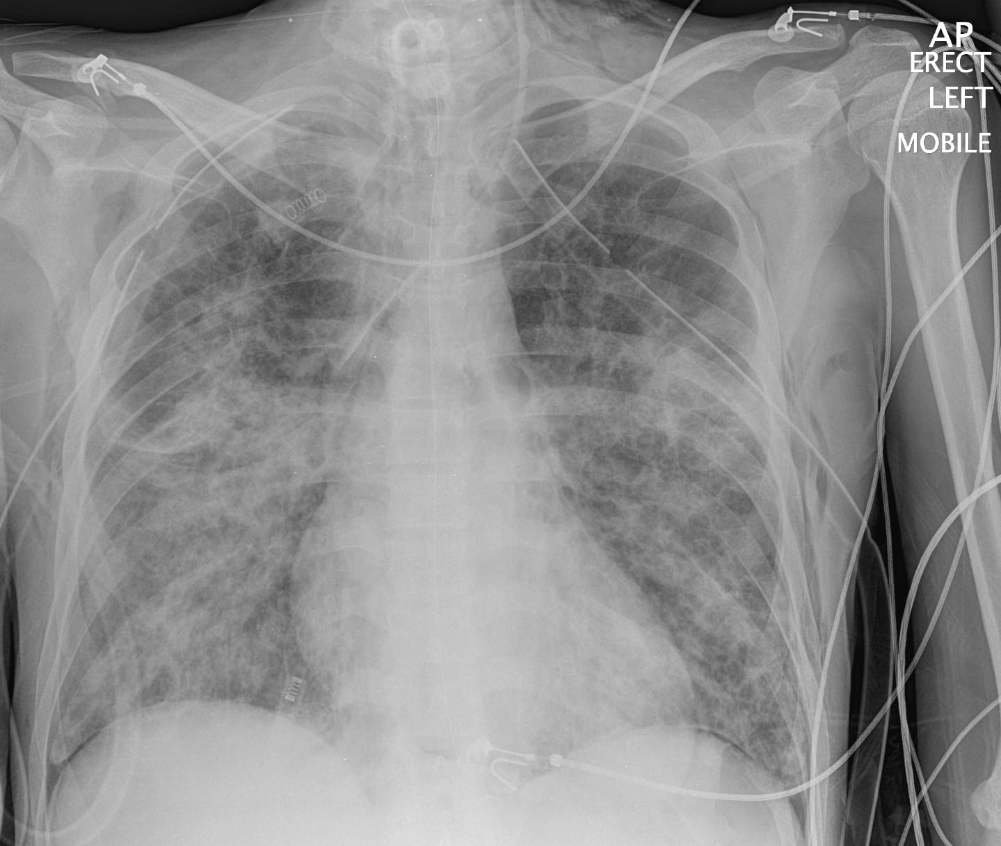 Emphysema Chest X Ray