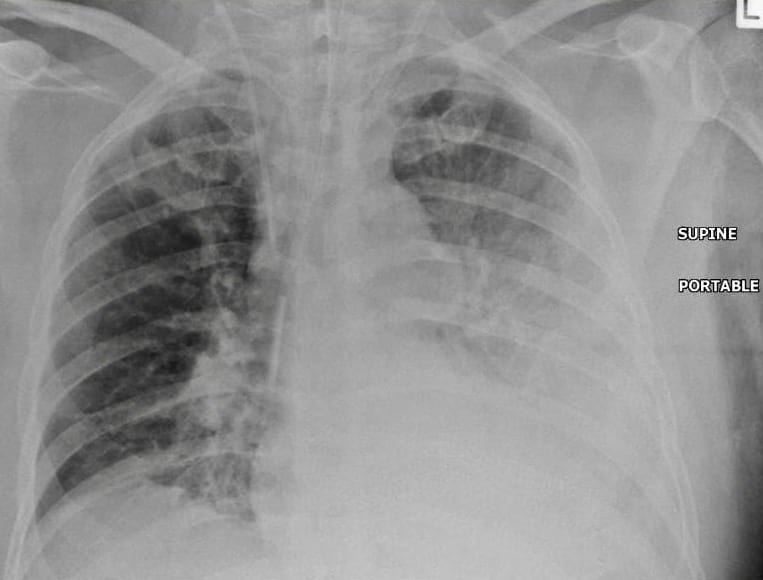 Pneumonia gone bad • LITFL • Pulmonary Puzzler