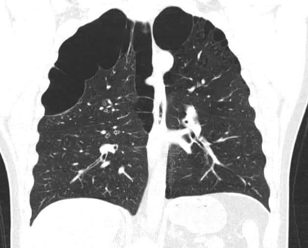 Copd Lung Chest X Ray