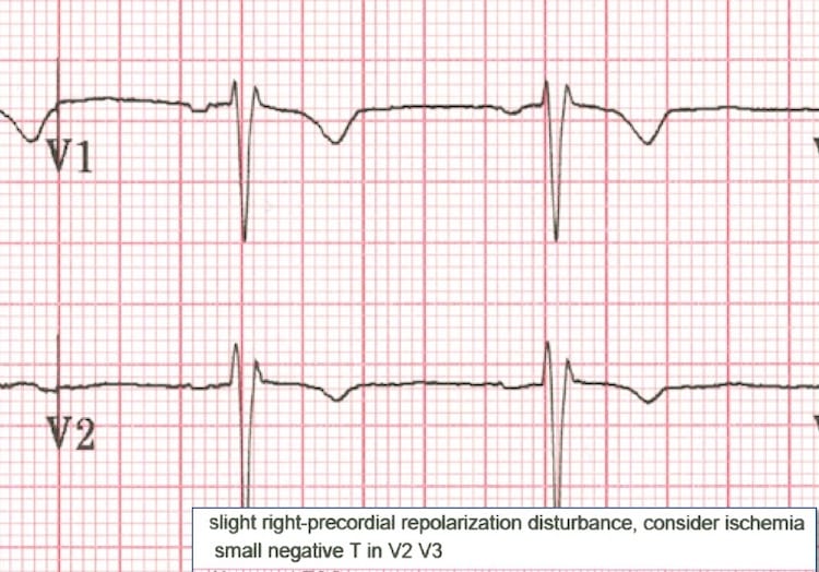 Misplacement of V1 and V2 • LITFL • ECG Library Basics
