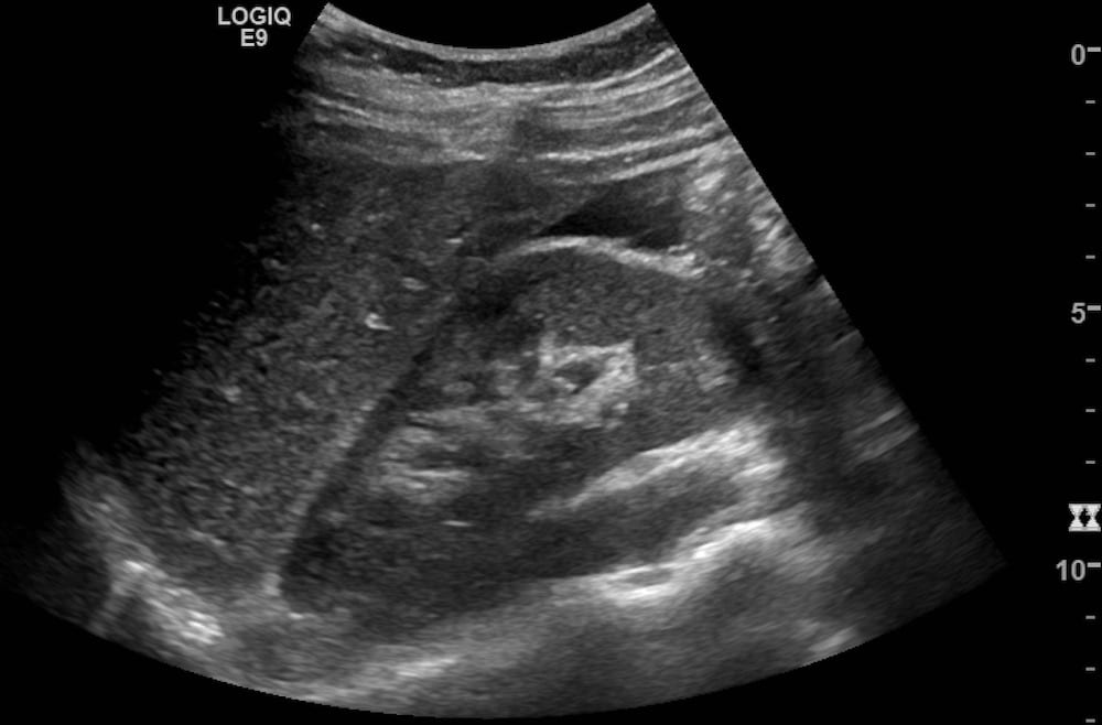 Ultrasound Case 013 • LITFL • POCUS SelfAssessment Quiz