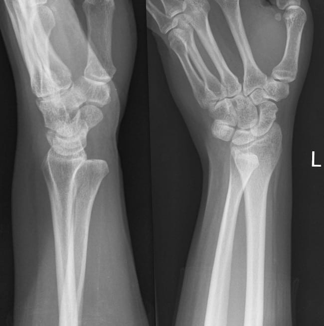 Distal Radioulnar Injury • LITFL • Clinical Cases Bamboozler