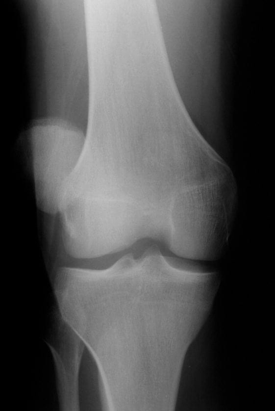 Patellar dislocation • LITFL • Trauma Library