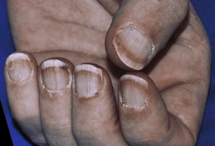 Terry's Nails • LITFL • Medical Eponym Library