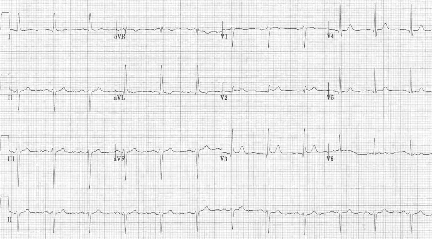 Left Anterior Fascicular Block (LAFB) • LITFL • ECG Library Diagnosis