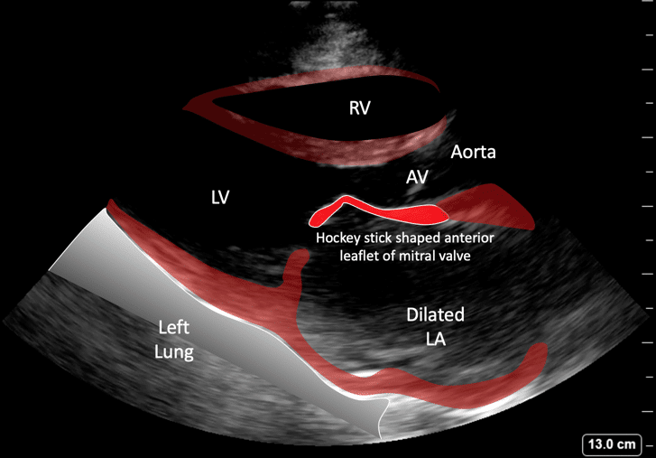 Ultrasound Case 110 • LITFL • POCUS Top 100
