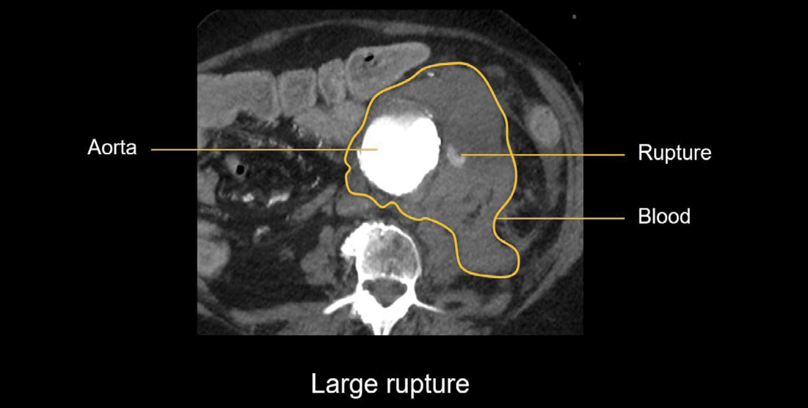 Abdominal CT aortic aneurysm • LITFL • Radiology Library