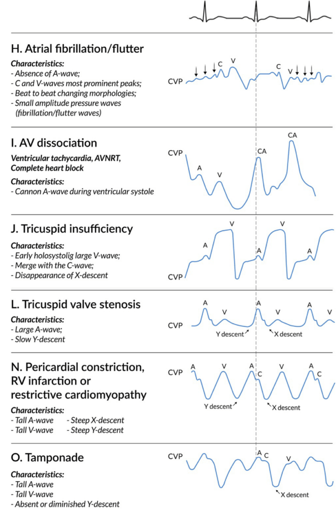 CVP Measurement • LITFL • CCC Equipment