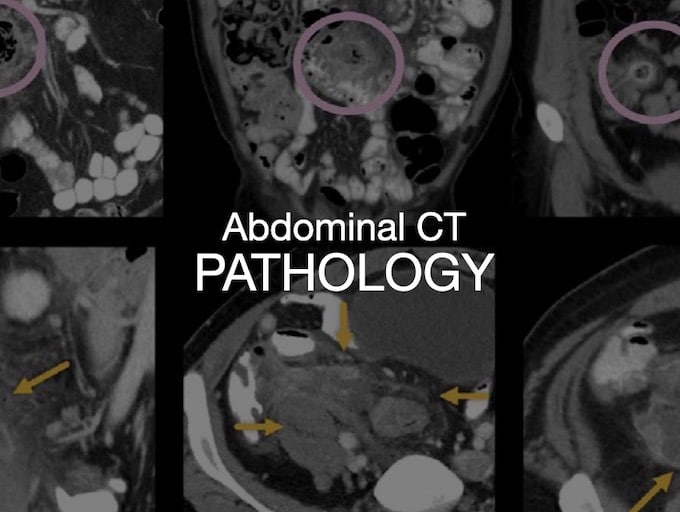 necrotizing pancreatitis Archives • LITFL