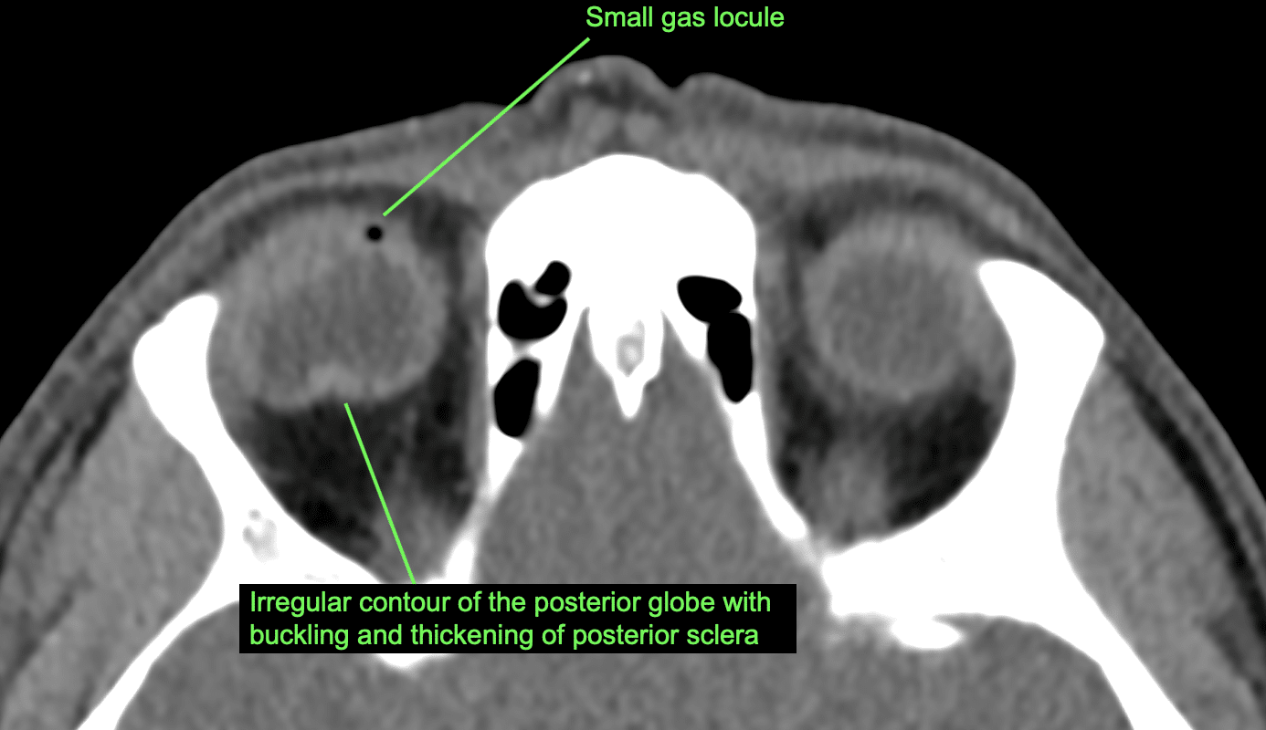 CT Case 020 • LITFL • CT scan interpretation