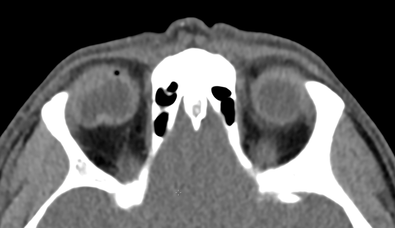 CT Case 020 • LITFL • CT scan interpretation
