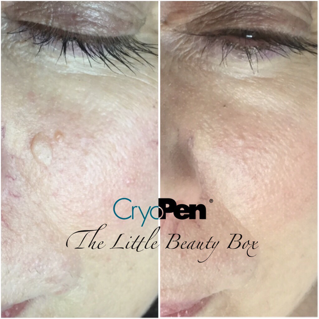 CRYOPEN SKIN BLEMISH REMOVAL The Little Beauty Box Lowton